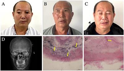 Case report: Peripheral nerve stimulation relieves post-traumatic trigeminal neuropathic pain and secondary hemifacial dystonia